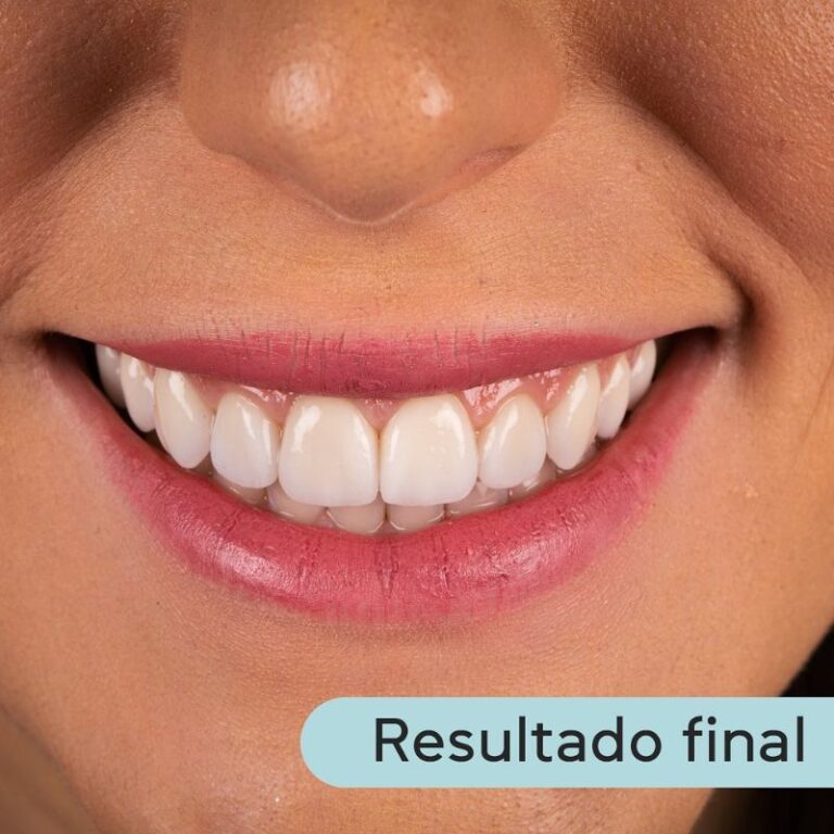 Diferencia entre carillas de porcelana y cerámica