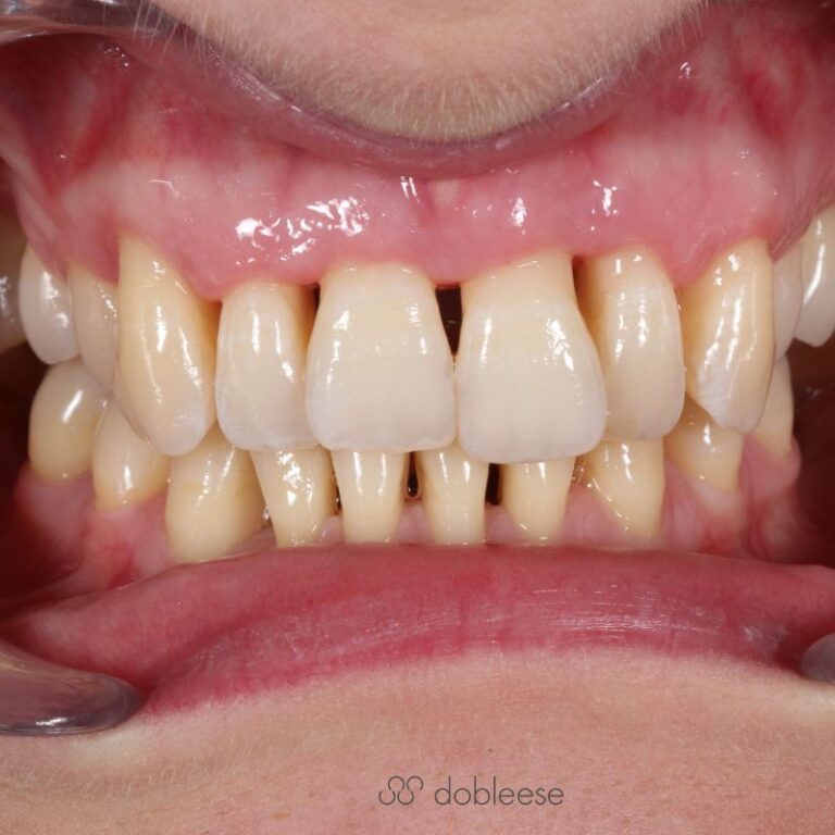 Tratamiento periodontal