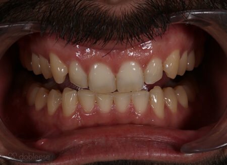 Blanqueamiento dental Luz LED en Sevilla Blanqueamiento dental Luz LED en Sevilla