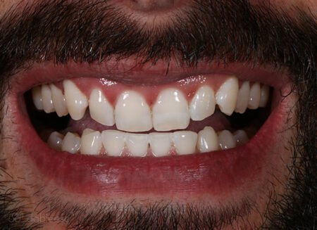 Blanqueamiento dental Luz LED en Sevilla Blanqueamiento dental Luz LED en Sevilla