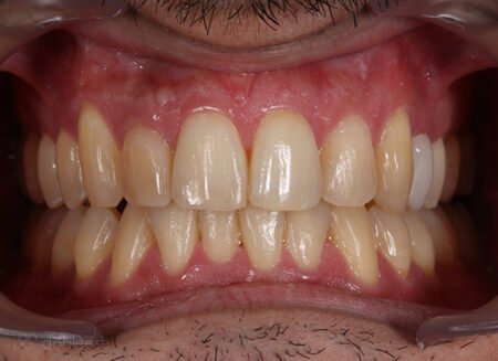 Blanqueamiento dental Luz LED en Sevilla Blanqueamiento dental Luz LED en Sevilla