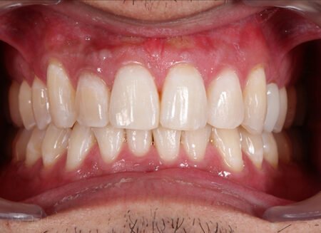 Blanqueamiento dental Luz LED en Sevilla Blanqueamiento dental Luz LED en Sevilla