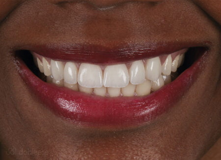 Carillas dentales de porcelana