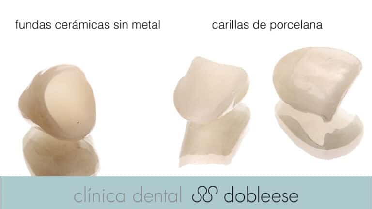diferencia hay entre fundas y carillas?
