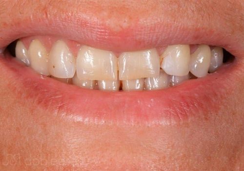 Caso real Asunción. Pasos del tratamiento dental