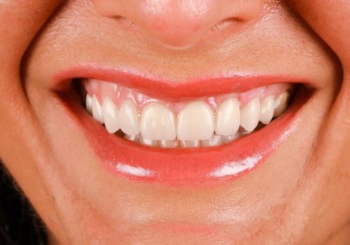 Caso real Asunción. Resultado después del tratamiento dental