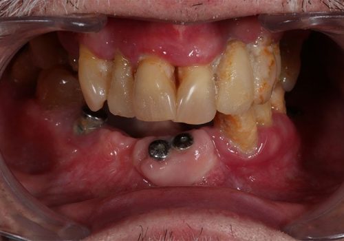 Caso real Miguel. Antes del tratamiento dental