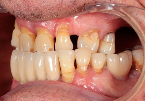 Caso real Pablo. Antes del tratamiento dental Caso real Pablo. Antes del tratamiento dental