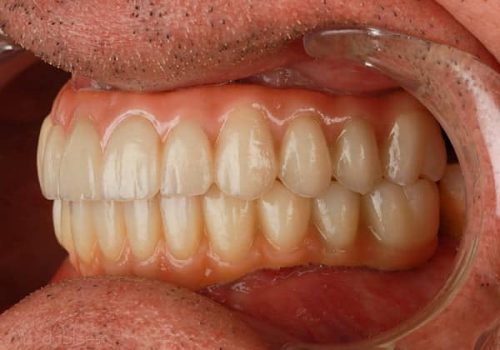 Caso real Pablo. Después del tratamiento dental Caso real Pablo. Después del tratamiento dental