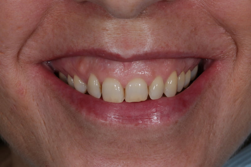 Caso real de Consuelo. Antes del tratamiento dental