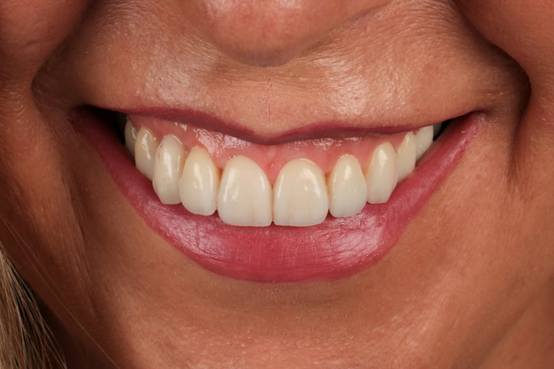 Caso real de Consuelo. Después del tratamiento dental