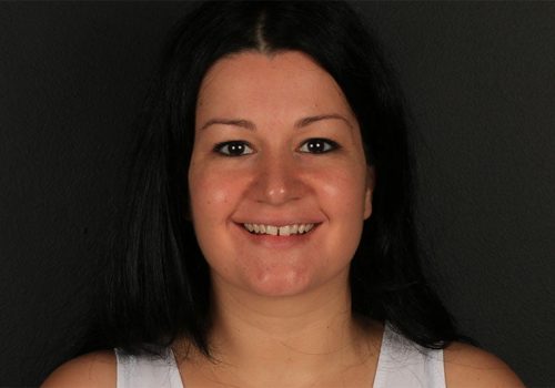 Caso real Isabel. Antes del tratamiento dental Caso real Isabel. Antes del tratamiento dental