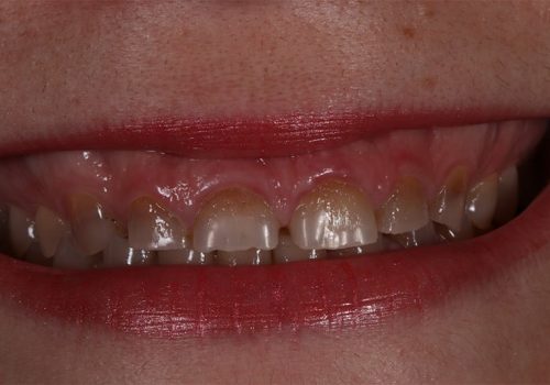 Caso real Mónica. Antes del tratamiento dental