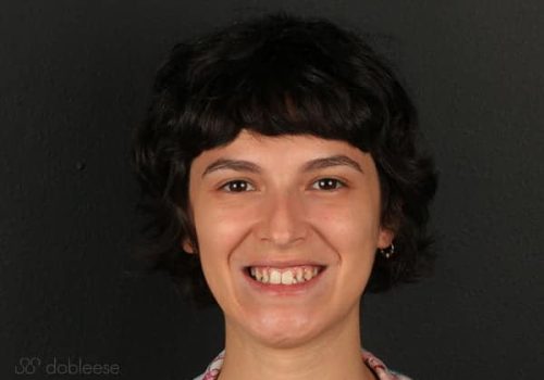 Caso real de Victoria antes del tratamiento dental