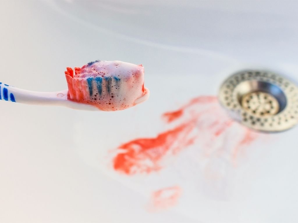 Causas y síntomas de gingivitis