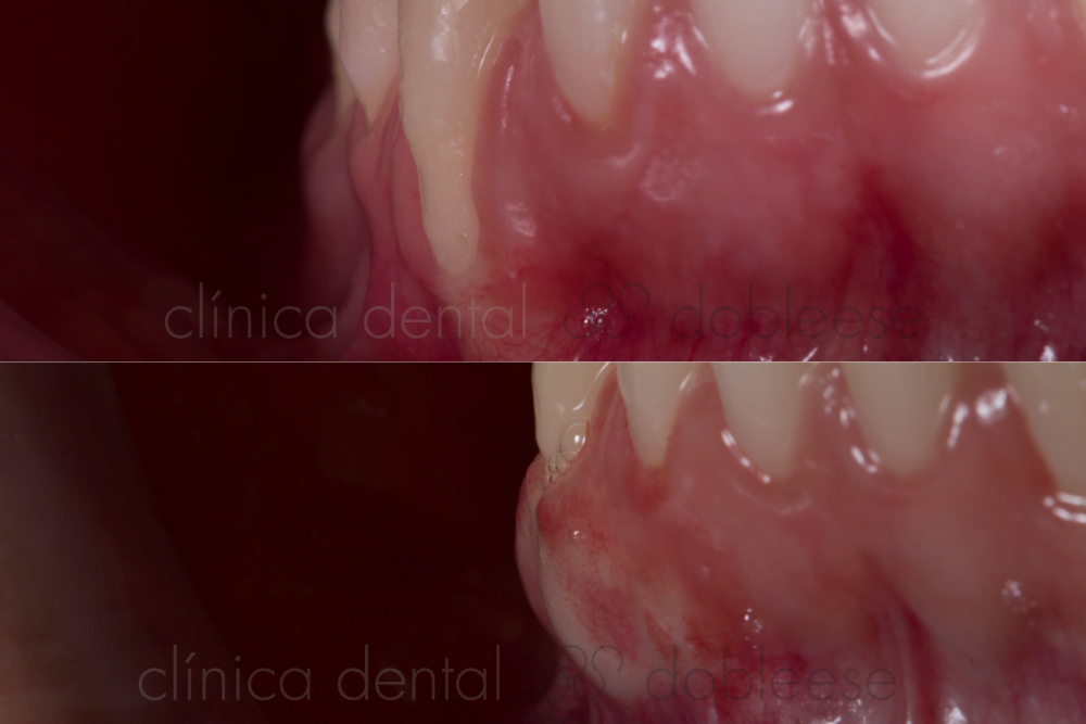 Cómo recuperar la encía retraída