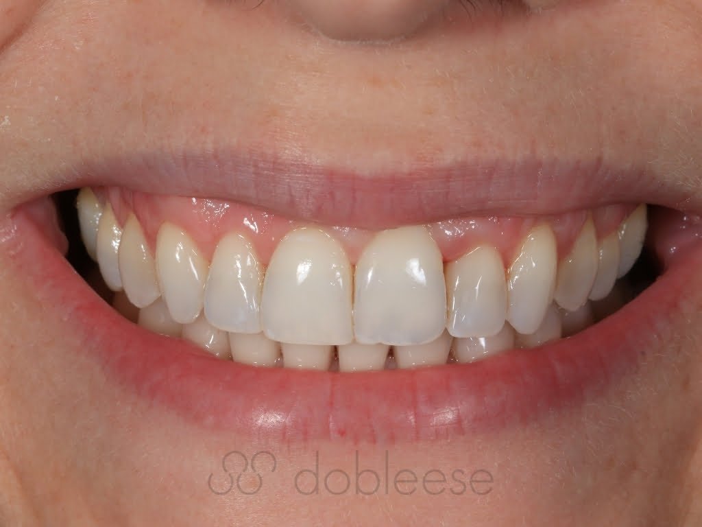 Dientes amarillos: solución profesional