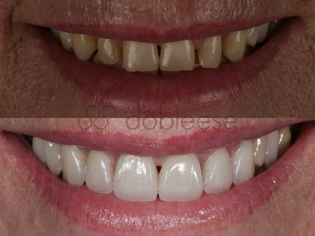 Qué soluciones hay a dientes amarillos