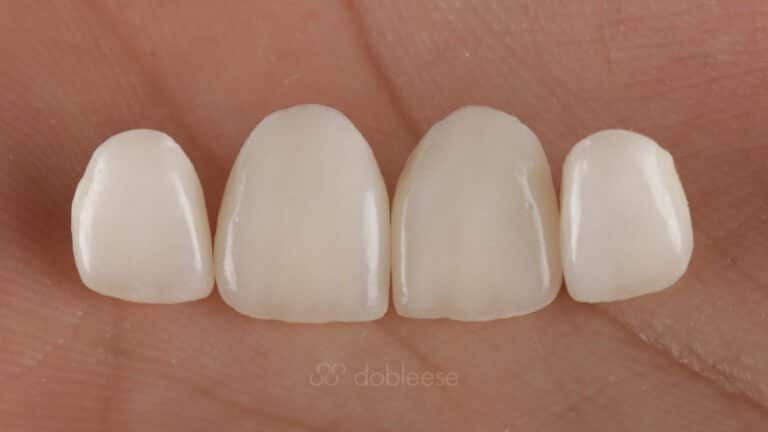 Diferencia entre carillas y fundas