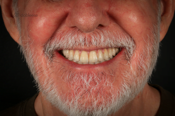 Soluciones para Falta de dientes