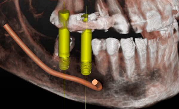 Fracaso implante dental