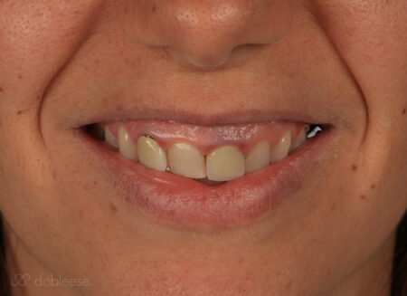 Gingivectomía Sevilla proceso 2 Gingivectomía Sevilla proceso 2