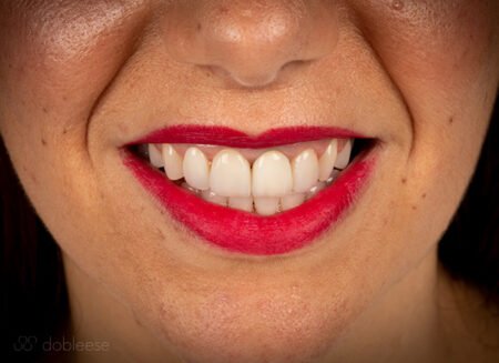 Gingivectomía Sevilla proceso 3 Gingivectomía Sevilla proceso 3