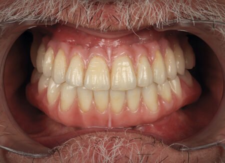 Implante dental 24 horas en Sevilla Paso 3