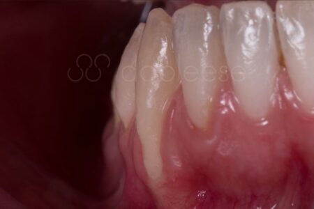 Injerto de encías antes y después - Caso 3 Antes