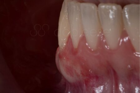 Injerto de encías antes y después - Caso 3 Antes