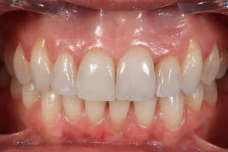 Injerto de encías antes y después - Caso 2 Antes