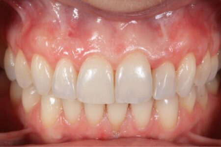 Injerto de encías antes y después - Caso 2 Después