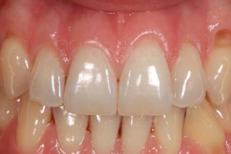 Injerto de encías antes y después - Caso 5 Antes