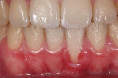 Injerto de encías antes y después - Caso 1 Antes