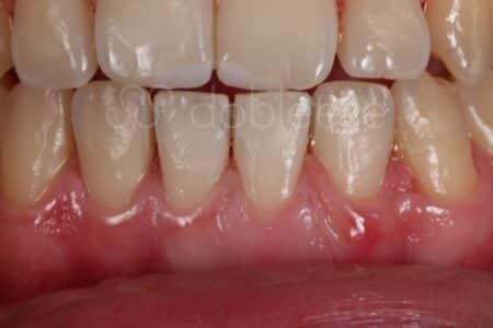 Injerto de encías antes y después - Caso 1 Después