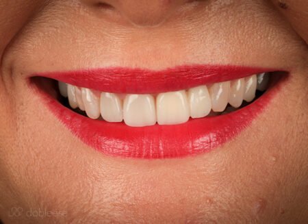 Injerto de encías. Foto proceso 3