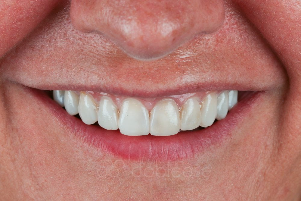 Las carillas dentales sirven para reparar dientes fracturados