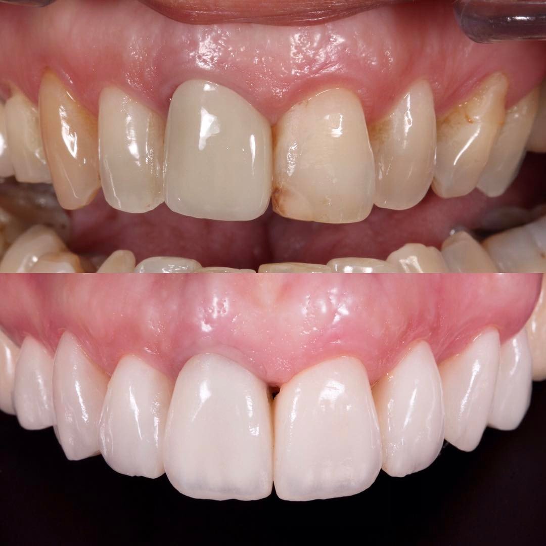 Para qué sirven las carillas dentales de porcelana