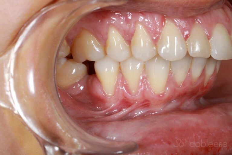 Caso real de pérdida de encía