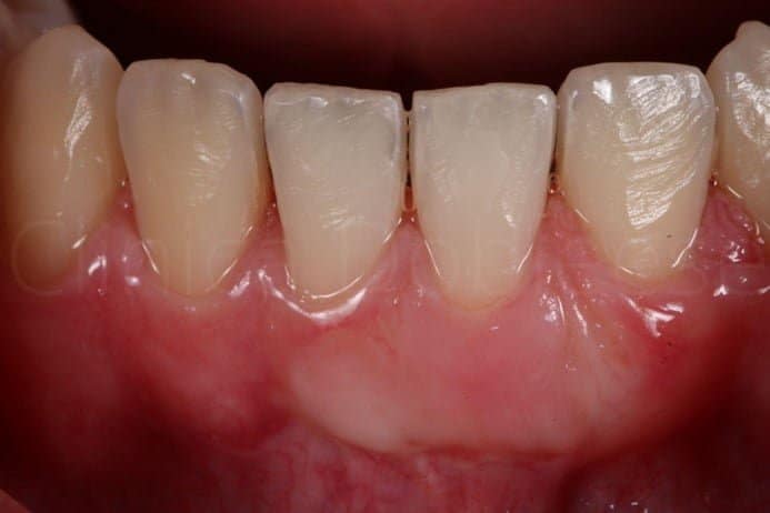 Caso después de recuperar encía