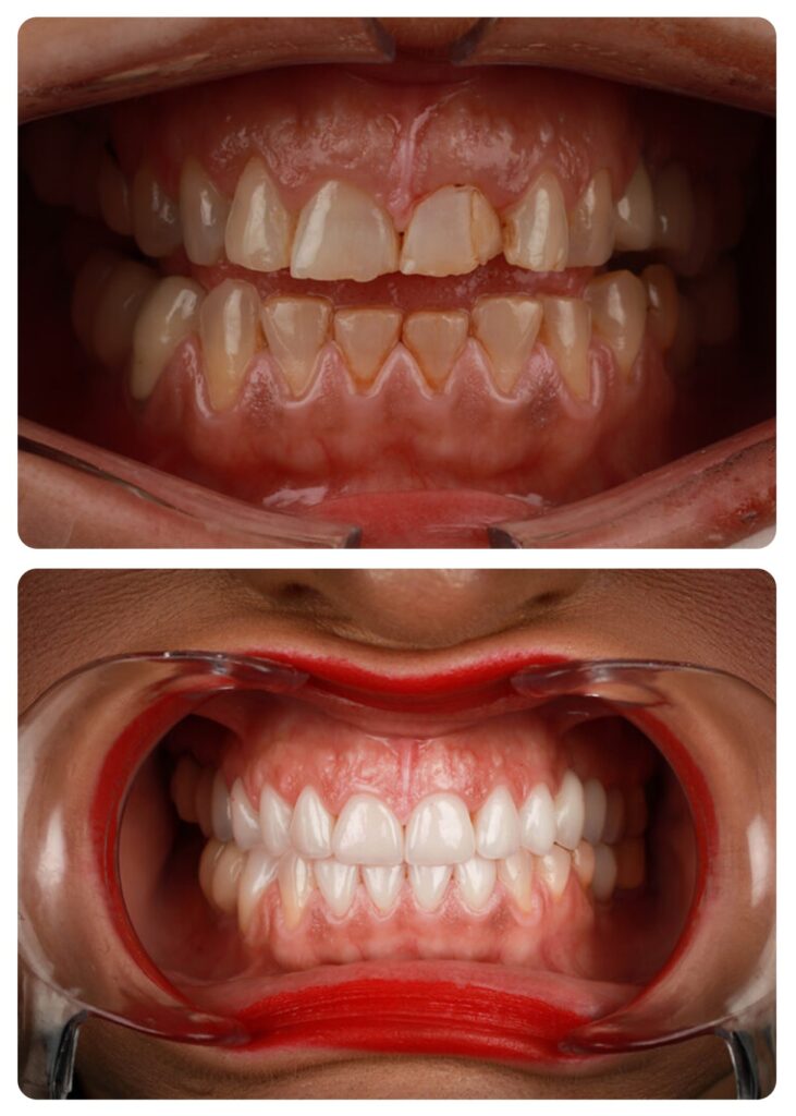 Caso real carilla dental