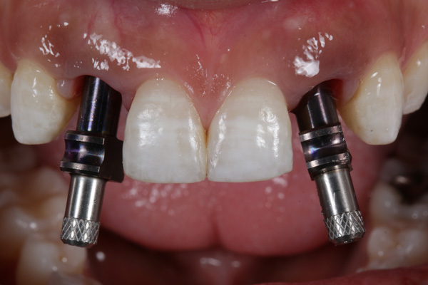 Rechazo implantes dentales