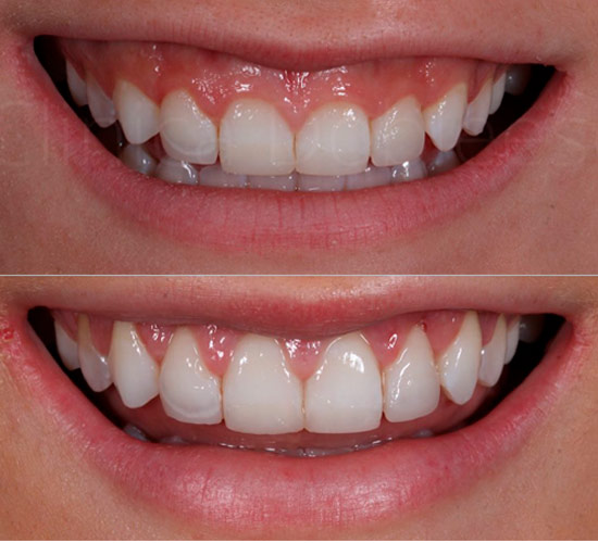 Resultado en los días posteriores al remodelado de la encía en Clínica Dental Dobleese