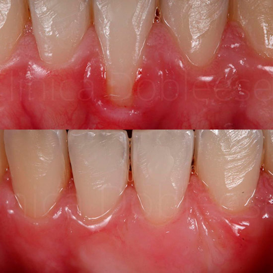 Resultado del tratamiento de encías retraídas mediante cirugía plástica mucogingival en Clínica Dental Dobleese