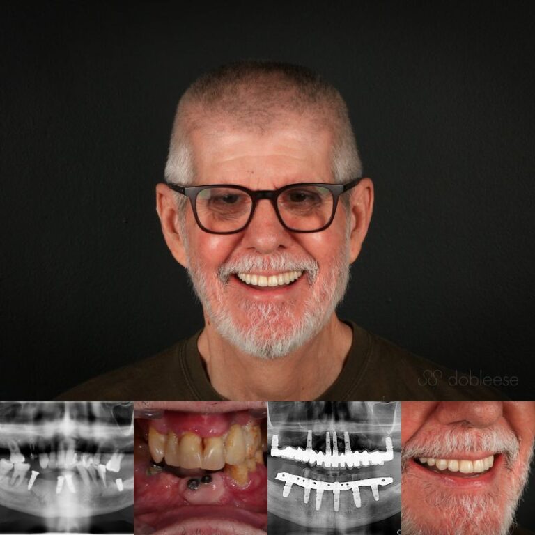 Causas por las que se mueve un implante dental