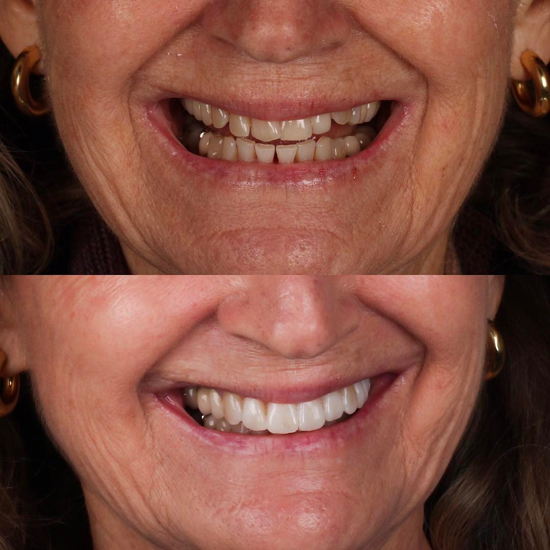 Las carillas dentales sirven para corregir defectos de posición dental