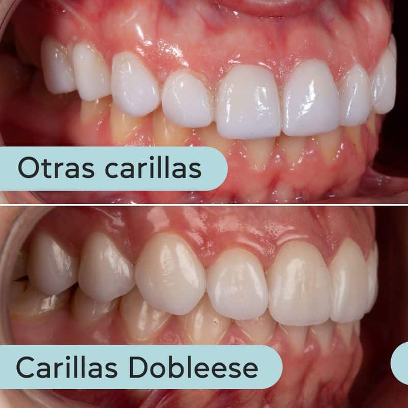 Qué son las carillas de porcelana para los dientes Qué son las carillas de porcelana para los dientes